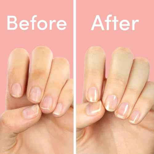 ella+mila "First Aid Kiss" Nail Strengthener and Growth treatment- Nail Repair Solution & Growth Treatment for Thin, Brittle & Damaged Nails - Nail Hardener with Vitamin E (0.45 fl oz)