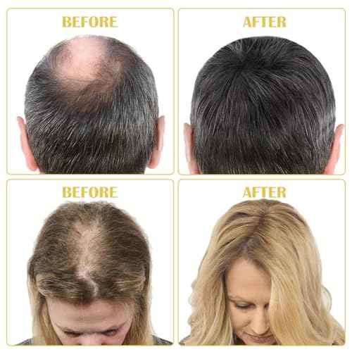 5% Minoxidil Hair Growth Serum Kit, Hair Regrowth Treatment for Scalp Hair Loss and Thinning, With Biotin - 2.02 Fl oz, 1 Month Supply