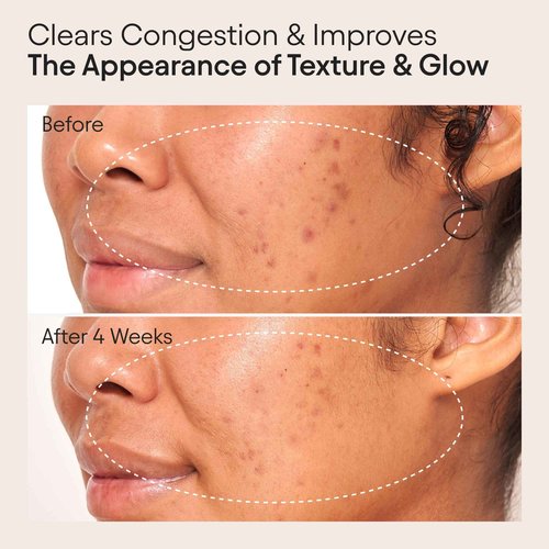 ALPYN Clarifying Facial Oil with Retinol & Pink Algae | Clear Congestion, Smooth Fine Lines, Improve Texture & Glow | 1 Fl Oz / 30 ml