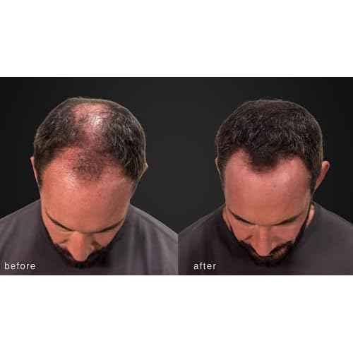 LUXE Hair Building Fibers - Thickening Fibers - CONFIDENCE IN A JAR ? 2 Months+ Supply! ? Hypoallergenic, Dermatologist Tested ? Multiple Colors Available (Dark Brown)