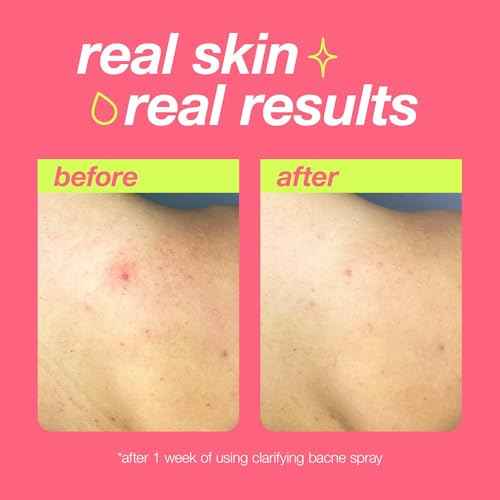 Dermalogica Clear Start Clarifying Bacne Spray, Back Acne Treatment Spray for Body Breakout - Pore Clearing, Preventing Pimple with Salicylic Acid, Witch Hazel, Tea Tree Oil, All Skin Type, 6 fl oz
