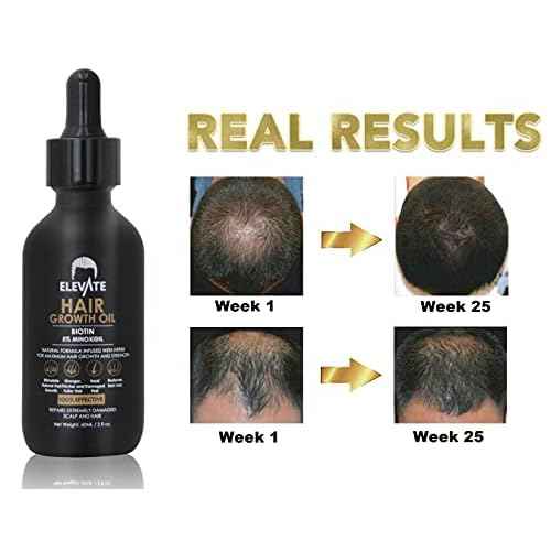 Elevate Hair Regrowth Treatment 5% Minoxidil Solution ? Biotin Serum Hair Growth Oil for Men & Women - Thicker Fuller Stronger Hair - Stops Hair Loss & Thinning - Natural Hair Thickening Treatment 2oz