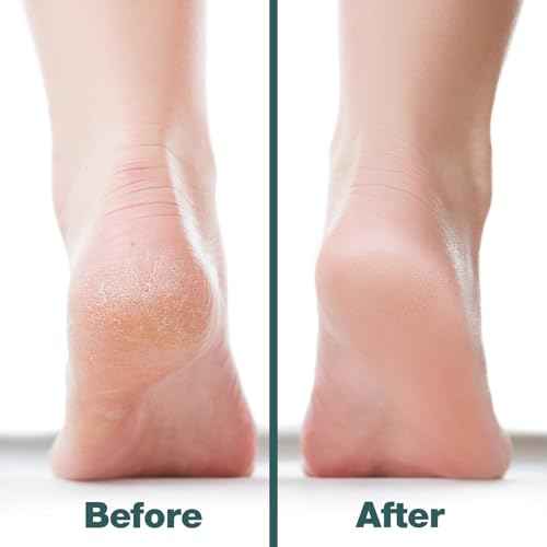 Probelle Double Sided Multidirectional Nickel Foot File Callus Remover - Immediately Reduces calluses and Corns to Powder for Instant Results, Safe Tool (Dark Grey)