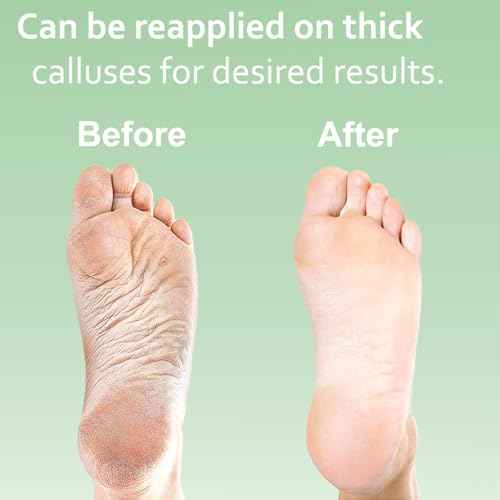 Callus Remover Gel & Double-Sided Foot File: 8 oz Extra Strength Callus Remover for Feet, Foot Callus Remover Care, Pedicure Tools Supplies, Spa Kit, Dead Skin Scrubber