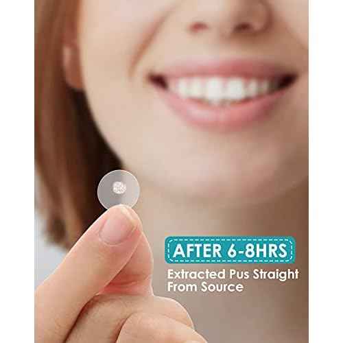 Acne Patches for Face - Hydrocolloid Pimple Patches with Tea Tree Oil for Spot Treatment, Zit Patch, Blemish Cover, Two Sizes, Vegan, Cruelty Free (108 Count (Pack of 1))