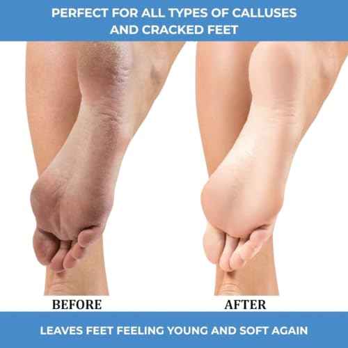 ForPro Professional Collection Advanced Callus Eliminator Gel, Professional Grade, No Drip Callus Remover Gel for Feet, 8 oz.