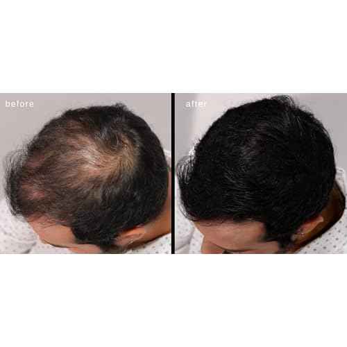 LUXE Hair Building Fibers - Thickening Fibers - CONFIDENCE IN A JAR ? 2 Months+ Supply! ? Hypoallergenic, Dermatologist Tested ? Multiple Colors Available (Dark Brown)