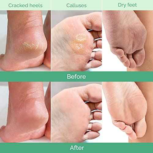 PLANTIFIQUE Foot Peeling Mask 2 Pack | Dermatologically Tested Repairs Heels & Removes Dry Dead Skin for Baby Soft Feet | Exfoliating Foot Peel Mask for Dry Cracked Feet | Peach