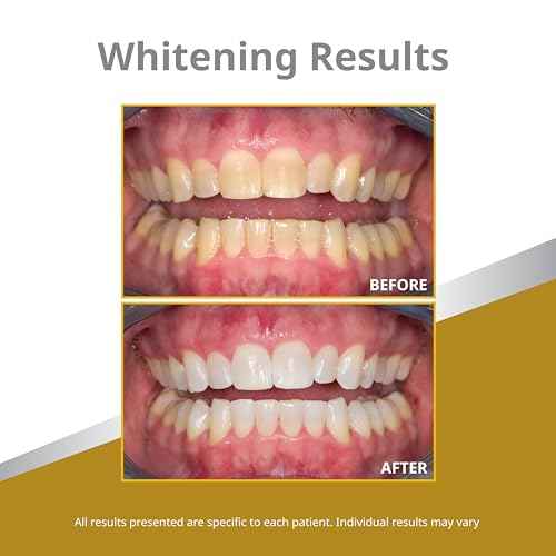 Opalescence 45% Syringes Teeth Whitening Gel - with PF - (4 Syringes) Refill Kit Carbamide Peroxide. Made by Ultradent, in Mint Flavor. Tooth Whitening 5359-2