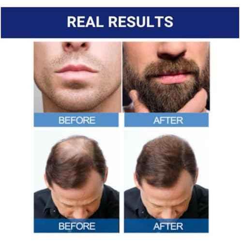 KIRKLAND SIGNATURE Minoxidil 5% Hair Regrowth Treatment for Men | 6 Months Supply | Topical Solution | Extra Strength | Clinically Proven | Unscented Drops | Dropper & Sprayer Included