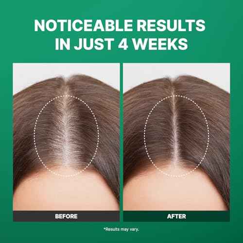 Spicule Microneedling Exosome Hair Growth Serum, Hair Loss Treatments for Women and Men, Peppermint Oil Cooling Scalp Serum, Menthol, Korean Hair Care (0.5 fl oz / 15ml)