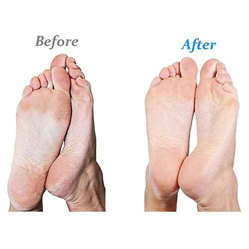 Emjoi Micro-Pedi Battery Operated Callus Remover