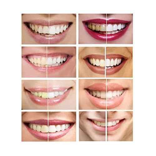 10 Syringes (3ml) New Strongest 44% Carbamide Peroxide Teeth whitening Gel (Mouth Trays NOT Included)