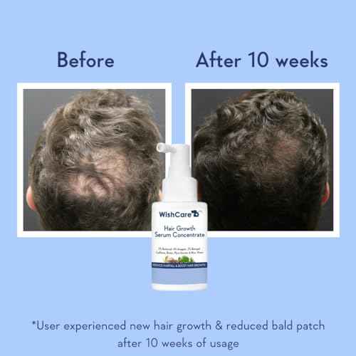 WishCare Hair Growth Serum Concentrate - Rosemary, 3% Redensyl, 4% Anagain, 2% Baicapil, Caffeine, Biotin, Plant Keratin & Rice Water