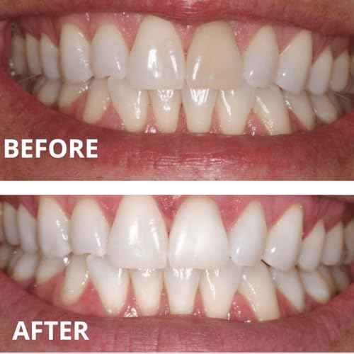 Teeth Whitening Gel Refills (6-gels). Made USA. 44 percent Carbamide Peroxide Tooth Bleaching Gel bleach For Invisalign style trays, Dental Grade Tooth Whitener. 6 syringes