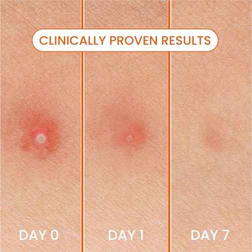 Biore Pimple Patches, Cover & Conquer Blemish Patch, Medical Grade Ultra-Thin Hydrocolloid for Covering Zits and Blemishes, HSA/FSA Approved, 30 Count