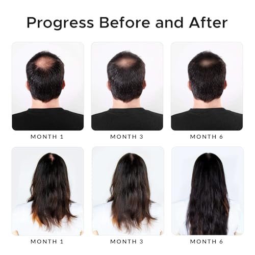 Minoxidil & Biotin Shampoo for Hair Growth - Enriched with Caffeine, Castor Oil & Onion - DHT Blocker for Thicker, Healthier Hair - Strengthening Formula for Men & Women