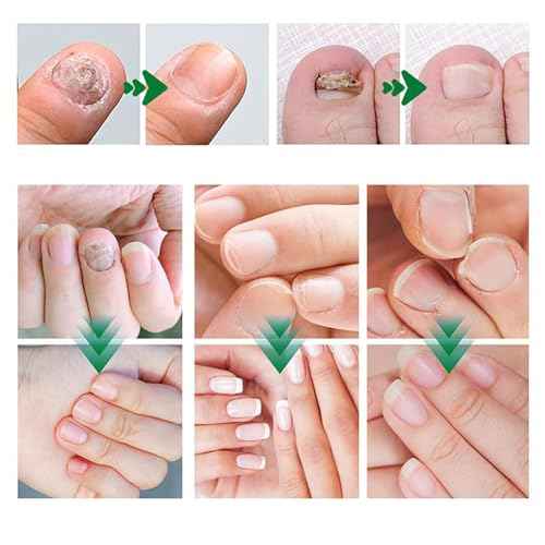 2PCS Nail Repair Gel, Nail Growth Repair Cream, Multi-Purpose Nail Repair