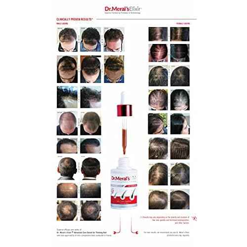 Dr. Meral's Elixir - Essential Hair Growth Products Kit: Minoxidil Free Thinning Hair Serum with Saw Palmetto & Sodium Lauryl Sulfate Free Shampoo for Hair Loss - DHT Blocker, Stimulates Hair Regrowth