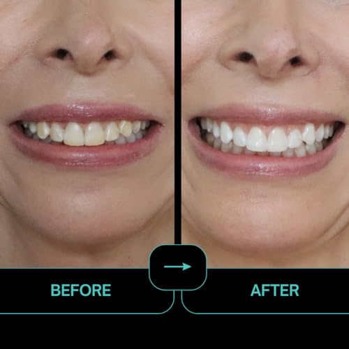 Prostrips - 12 Shades Whiter Teeth - 56 Enamel Safe REMINERALIZING Gentle Strips ? 97% Had No Sensitivity - Bonus Size