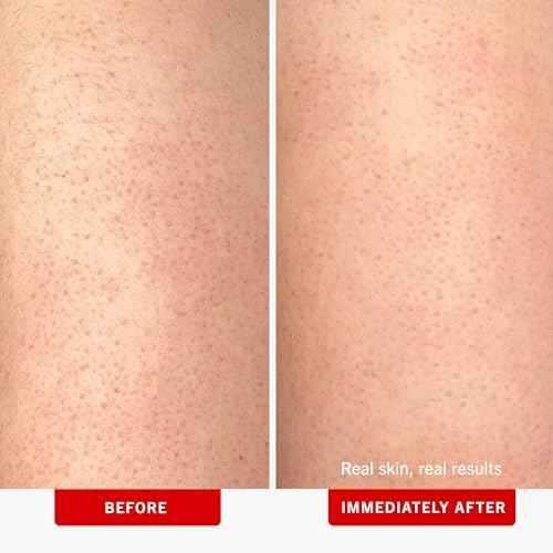 First Aid Beauty - KP Bump Eraser Body Scrub with 10% AHA, Keratosis Pilaris Skin Exfoliater with Glycolic and Lactic acids, Helps Reduce Chicken Skin Bumps, Safe for Sensitive Skin, 10 oz
