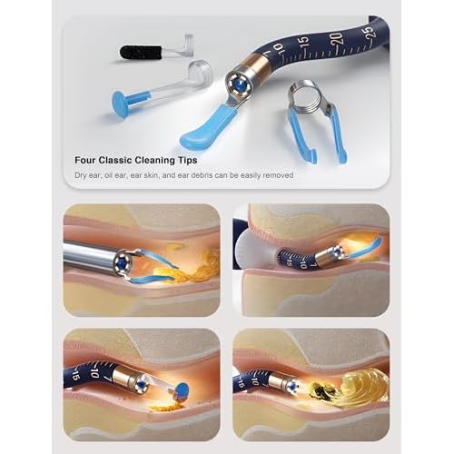 BEBIRD Earsight Plus Ear Wax Removal Tool Camera with HD Visual Otoscope, Smart WiFi Earwax Cleaner Kit, Safe Silicone Flexible Scoops & Tweezers Tools for Adults & Kids (Blue)