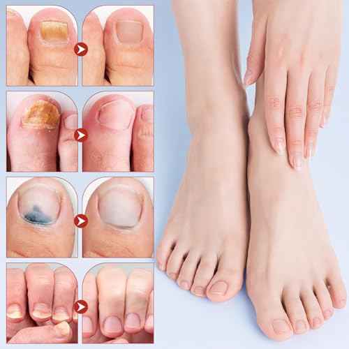 Toenail Treatment Extra Strength - Nighttime Nail Patches,Overnight Toe Nail Treatments for Damaged Nails Foot Nails Repair and Care (21Pcs)