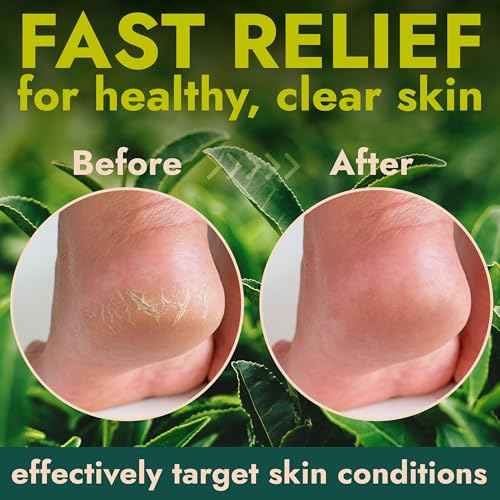 14 Oz Callus Remover Gel+ 3 Free Pumice Stones| Callus Remover For Feet | Tea Tree Professional Grade Foot Exfoliant for Cracked Heels & Dry Feet | Instant Results & Soothing Hydration