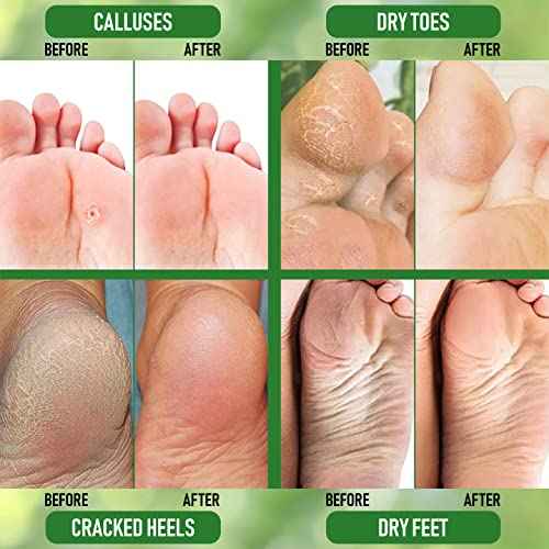 Urea 20% Healing Cream 4 oz - Best Callus Remover - Moisturizes and Rehydrates Hands, Feet and Knees to a Healthy Appearance - Soothes and Softens Thick, Cracked, Rough Dead and Dry Skin