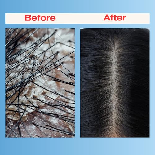 Therapro Mediceuticals Scalp Treatment - 3 Piece Kit (for Dandruff & Psoriasis)
