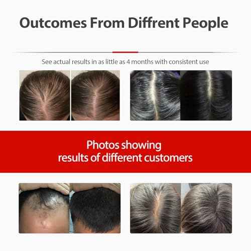 Laser Cap, Red Light Therapy for Hair Growth in Women and Men