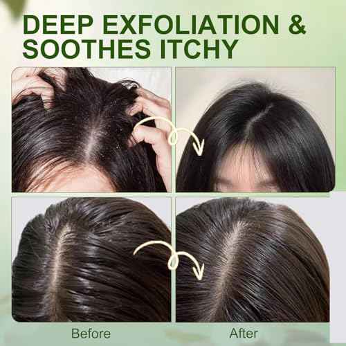 Scalp Scrub, Scalp Exfoliator with Rosemary & Mint, Hair Treatment for Itchy Scalp, Dandruff & Buildup Removal, Scalp Treatment with Scalp Massager for Detox & Nourishment / 8.8oz