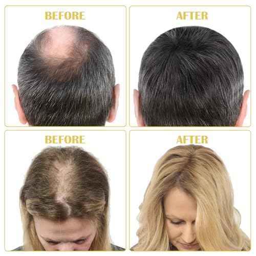 5% Minoxidil for Men Hair & Beard, Minoxidil for Women Hair Growth Oil, Topical Hair Regrowth Treatments Beats Hair Loss, Revitalizes Hair Follicle, 2 Oz 1 Month Supply