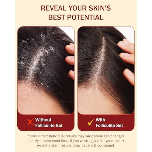 Folliculitis 3-Piece Set - Folliculitis Shampoo, Dry Scalp Serum & Body Spray with Salicylic Acid, Tea Tree Oil & Peppermint Oil - Soothes Itchy Scalp, Razor Bumps & Blemishes by e70