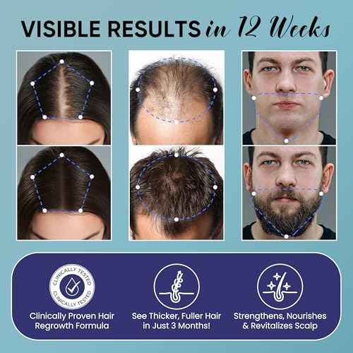 Minoxidil for Men and Women Hair Growth: 5% Minoxidil Spray Hair Regrowth Treatment Serum with Biotin & Rosemary -Stop Hair Thinning and Hair Loss For Stronger Thicker Longer Hair - 2 Pack
