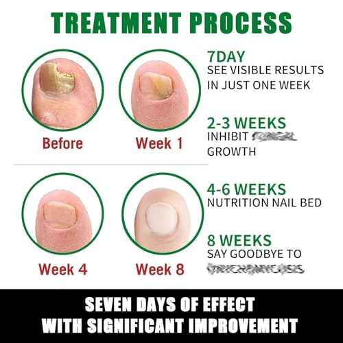 Ginger Nail Treatment Nail Support Nail Care, 7days Nail Treatment, Ginger Nail Growth Serum, Ginger Cuticle Care Oil for Nails,Cuticle Serum for Nails (2Pcs, 1 Fl.oz(pack of 1))