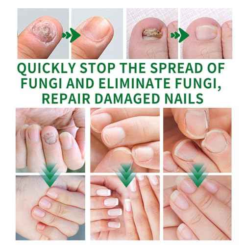 Ginger Nail Treatment, Ginger Cuticle Care Oil for Nails (2 PCS)