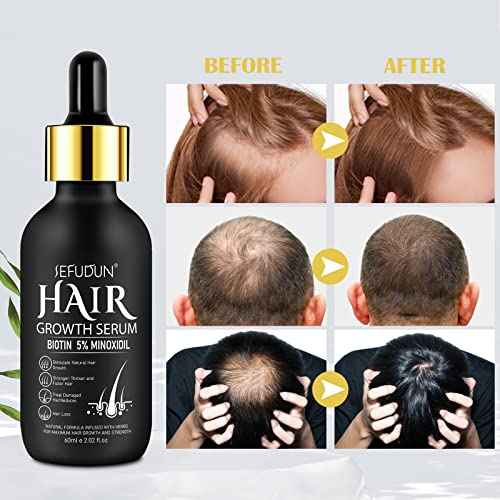 2 Pack 5% Minoxidil Hair Growth Serum,Minoxidil For Men and Women Hair,2.02 oz Biotin Hair Regrowth Serum Treatment For Getting Thicker Healthier Hair