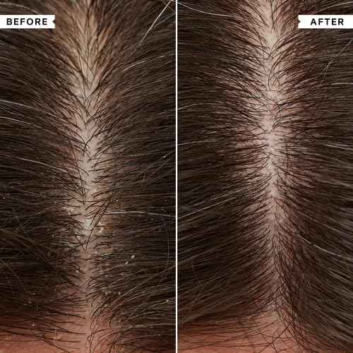 PHILIP KINGSLEY Conditioner for Flaky Scalp, 6.76 fl oz - Hydrating, Nourishing, Moisturizing, Detangles, Moisturizes Dry Hair, Suitable for Oily and Dry Scalps, Paraben Free, Vegan