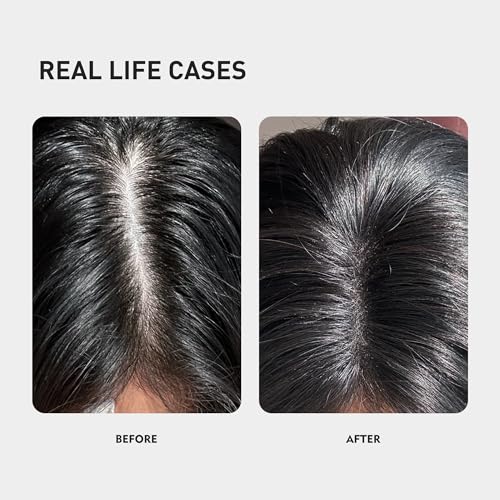 KINTOR 0.5% KX-826 Hair Growth Spray DHT Blocker Hair Regrowth Products,Nourish Hair follicles,Hair Oil Control Products For Men&Women-1 Month Supply 60ml