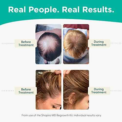 Shapiro MD Hair Growth Experts Hair Loss Shampoo and Conditioner, DHT Fighting Vegan Formula for Thinning Hair Developed by Dermatologists, Experience Healthier, Fuller & Thicker Looking Hair