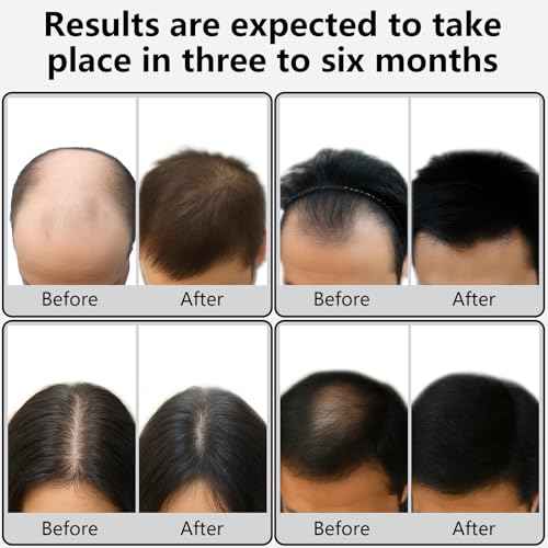 Laser Therapy Hair Growth Comb, Models: Lasercomb-001