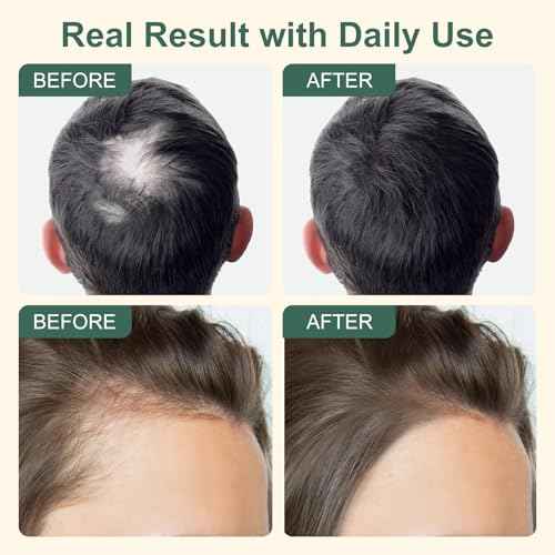 5% Minoxidil Hair Growth for Men and Women, Extra Strength Minoxidil Hair Loss Treatment Serum with Biotin & Herbal Extracts for Faster Thicker Stronger Hair Growth 60mL