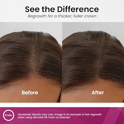 Minoxidil for Women 5% Foam - Helps Restore Top of Scalp Hair Loss and Support Hair Growth for Women, Regrowth with Unscented Topical Treatment for Thinning Hair (5% Foam 8-Month Supply)