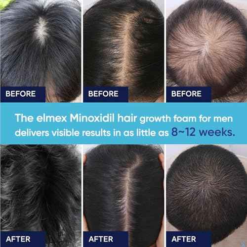5% Minoxidil Foam for Men and Women, 5% Minoxidil for Men Foam, Minoxidil for Women Hair Growth (60ML)