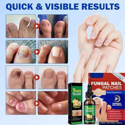 Fungal Nail Patches & Ginger 7 Days Nail Treatment ? Daily Nail Support for Stronger, Clearer Looking Nails ? Easy-to-Use Hydrogel Patches + Natural Formula, 21 Patches & 30ml