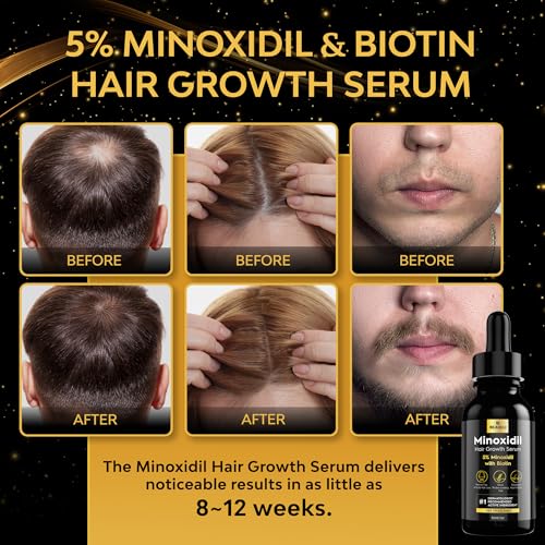 5% Minoxidil for Men & Women Hair Growth, Beard Growth, Hair Loss Treatment, Unisex Adult, Unscented Foam, 1oz