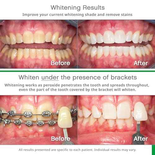 Opalescence Go 10% - Prefilled Teeth Whitening Trays Kit (10 Treatments) - 10% Hydrogen Peroxide - Mint Made by Ultradent Products. Go Teeth Whitening Kit -Mint- GO10-5193-1