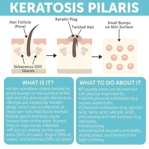 KP Bump Eraser Body Set | Keratosis Pilaris Treatment | Keratosis Pilaris Lotion | Exfoliating Body Scrub | Ingrown Hair Treatment | Bundle Set for Bump, Strawberry Legs, Redness, Dry & Flakey Skin