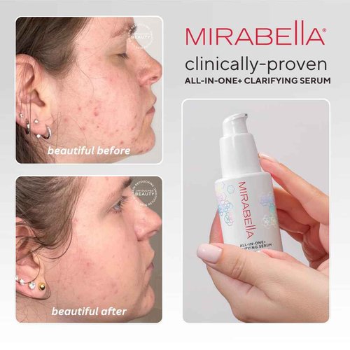 Mirabella All In One Clarifying Serum Micro Peel for Anti Aging - Hydrating 7% Glycolic Acid & 8.8% Lactic Acid Serum Face Peel with AHA BHA Exfoliant, 1 Oz